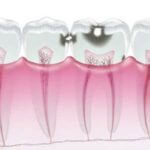 C2：象牙質までの虫歯