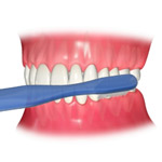 初期の虫歯の治療