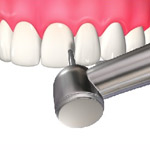 エナメル質までの浅い虫歯の治療2
