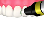エナメル質までの浅い虫歯の治療