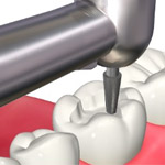 象牙質までの虫歯の治療2