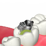 象牙質までの虫歯の治療