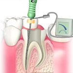 神経まで到達した虫歯の治療1