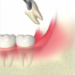 ほとんど歯がない虫歯の治療