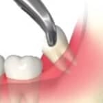 歯根部の除去
