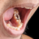 奥歯の銀歯