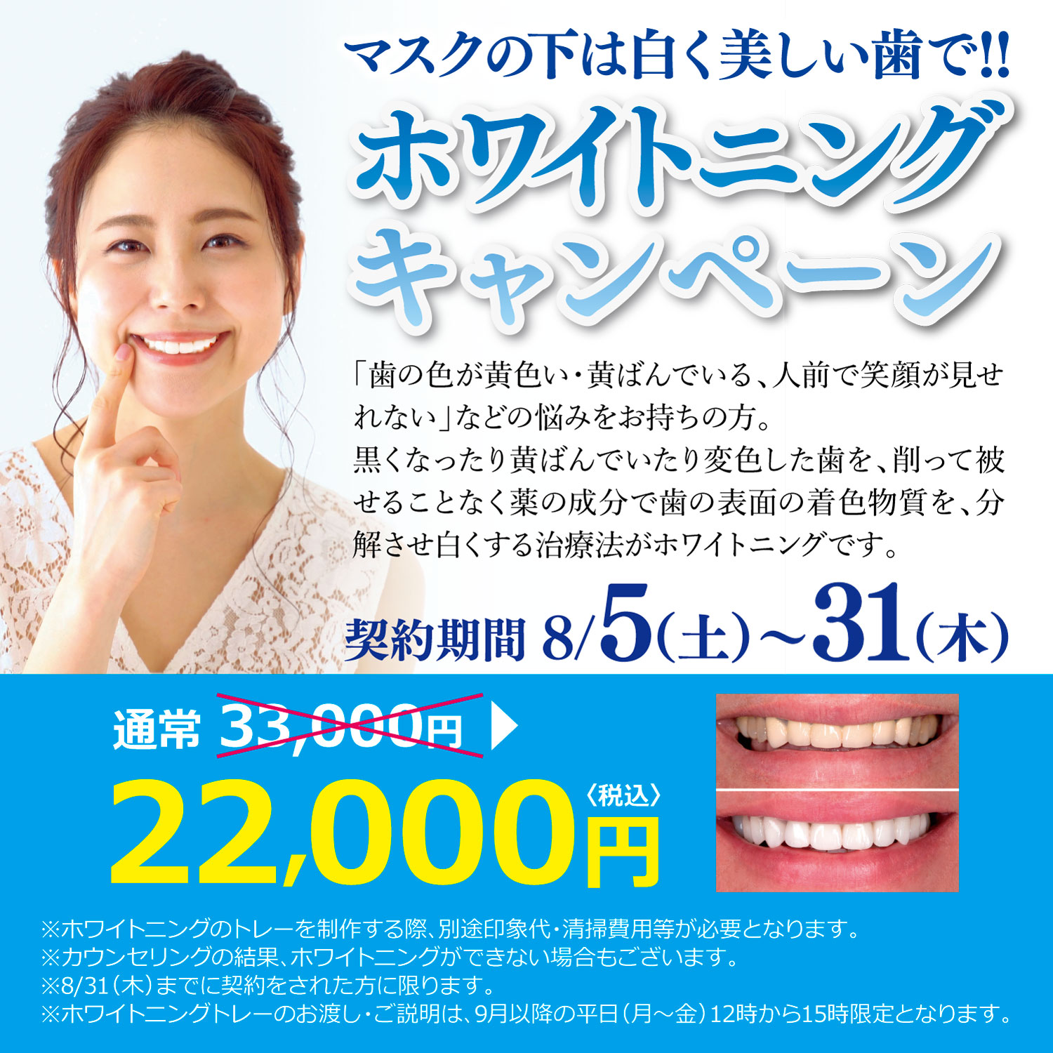 8月ホワイトニングキャンペーン | 大木歯科・矯正歯科 四日市