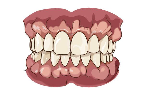 歯ぎしり-骨隆起