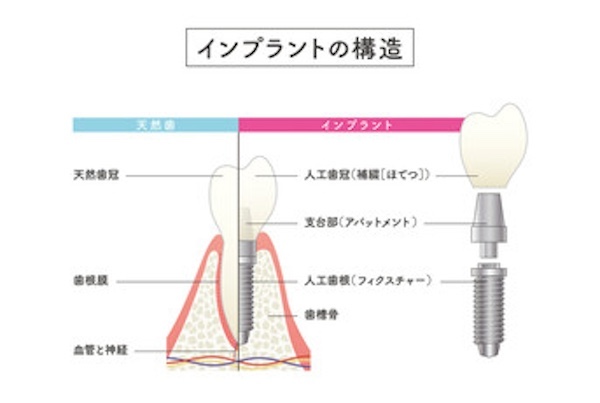 インプラントの部品