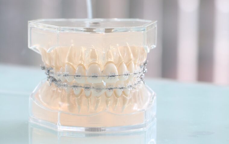 クリアブラケット